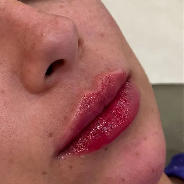 Preenchimento labial com resultado natural