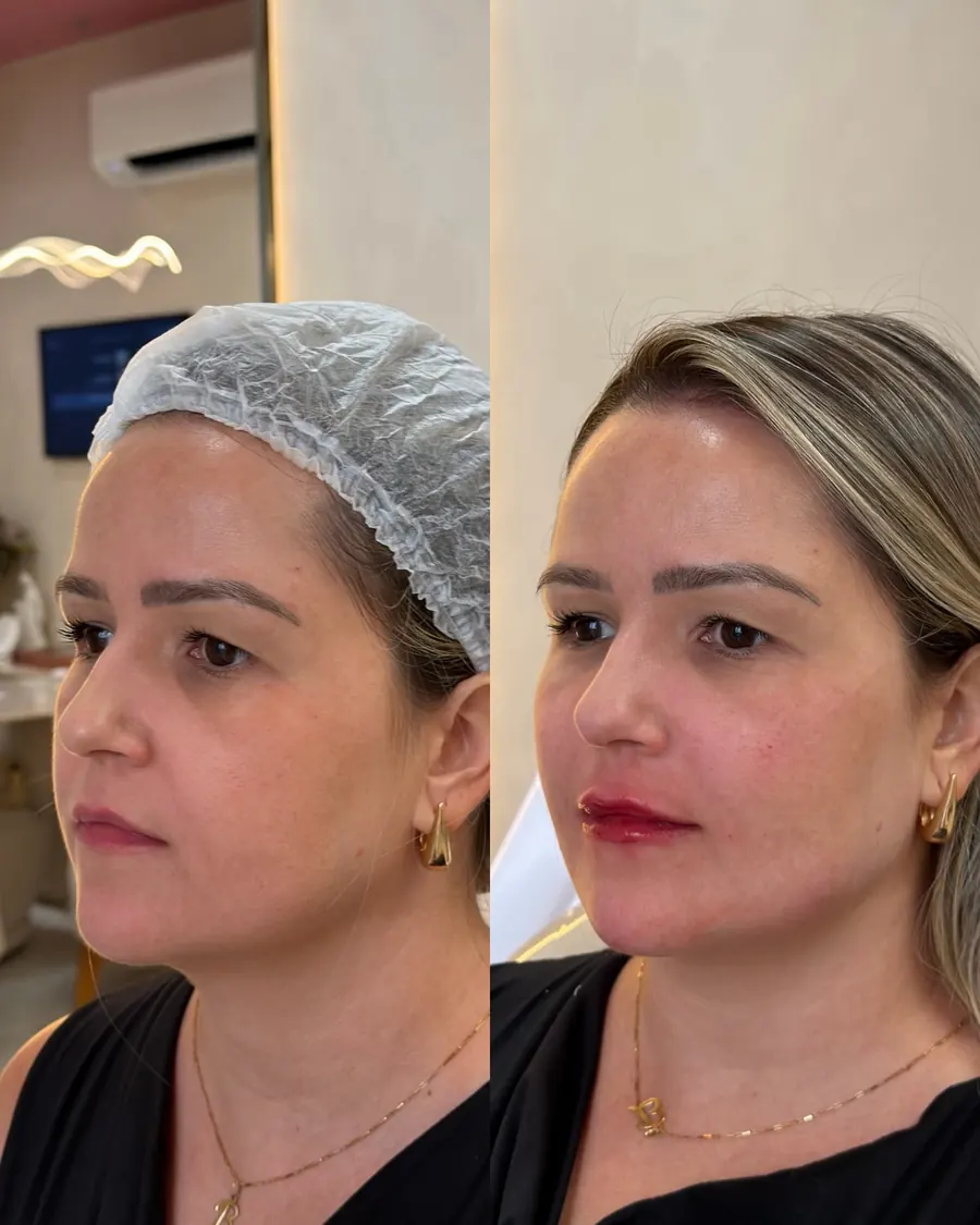 Full Face antes e depois, primeira harmonização da paciente