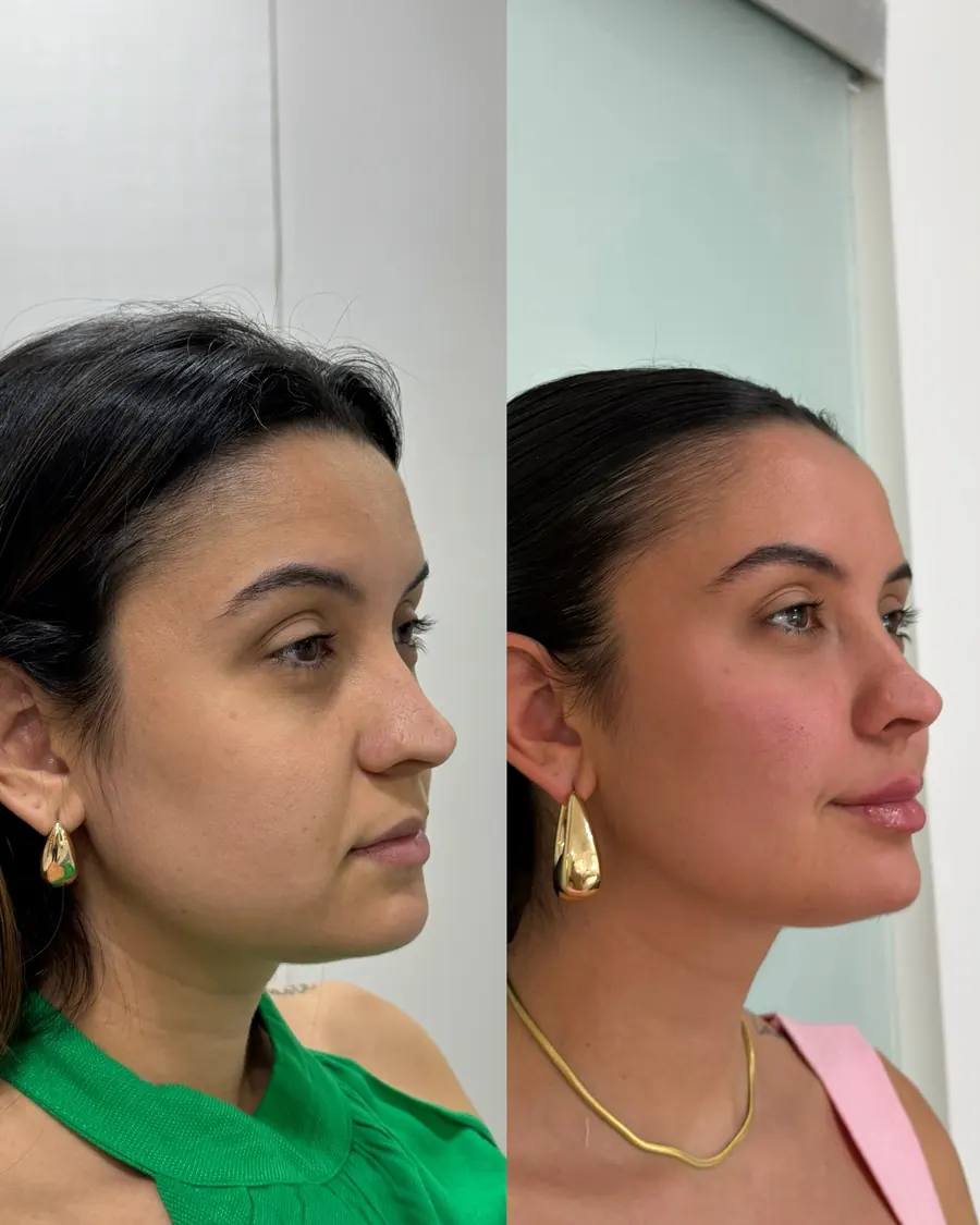 Harmonização facial antes e depois, tratamento do aspecto de rosto cansado