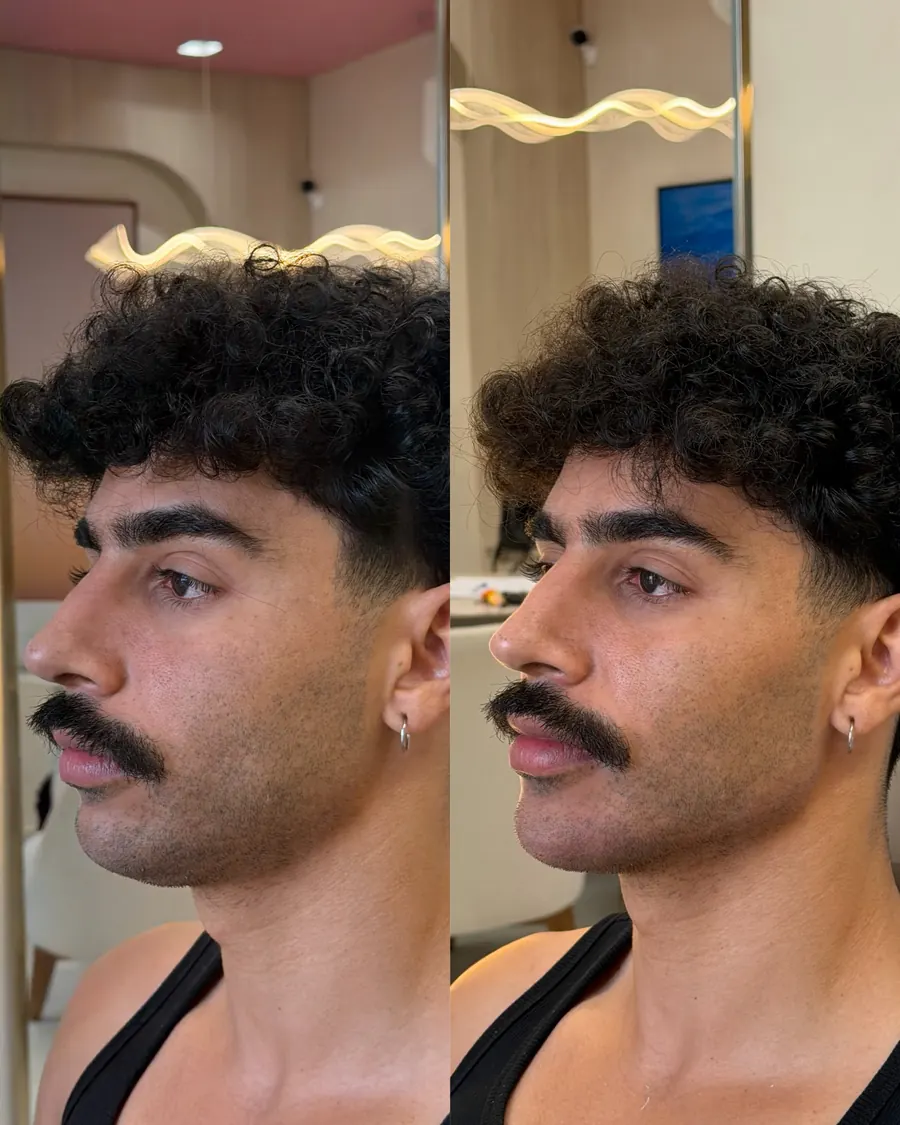 Contorno mandibular e mento antes e depois em paciente homem, vista de perfil